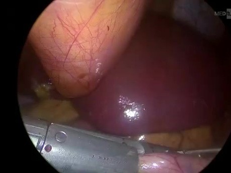 Gastrectomie Sleeve Laparoscopique