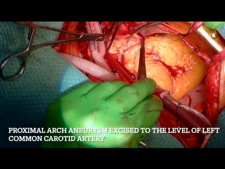 Anévrisme de l'aorte ascendante impliquant la partie proximale