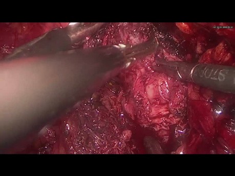 Adénomectomie prostatique par voie laparoscopique