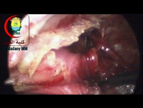 Les instruments laparoscopiques de 3 mm sont fragiles mais préférables pour une utilisation chez les Nourrissons