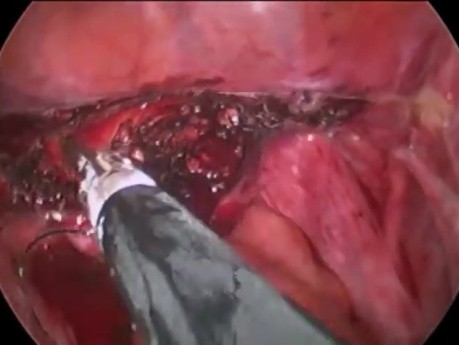 le suture sans nœud, V-loc