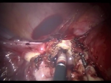 Hystérectomie robotique par incision unique.