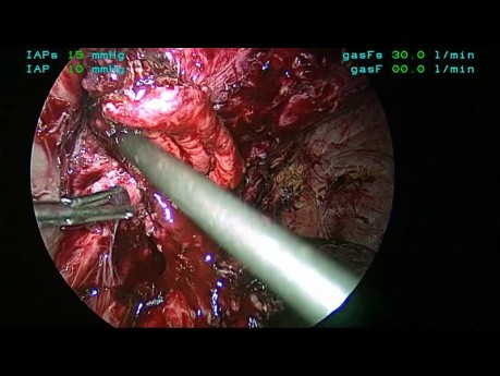 Ablation Laparoscopique de Maillage Erodé et Révision de la Gastro-jéjunostomie