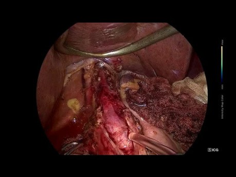 Cardiomyotomie de Heller Laparoscopique + Fundoplicature Dor