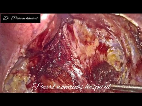 Vaginoplastie péritonéale laproscopique