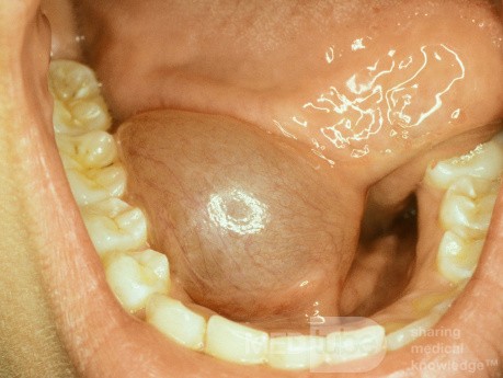 Grenouillette dans le plancher buccal (côté droit)