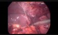 Proctocolectomie totale avec une poche en J et une anastomose iléoanale