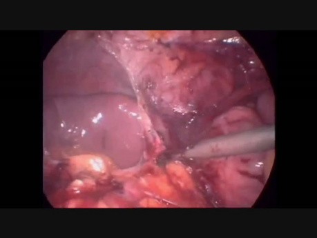 Proctocolectomie totale avec une poche en J et une anastomose iléoanale