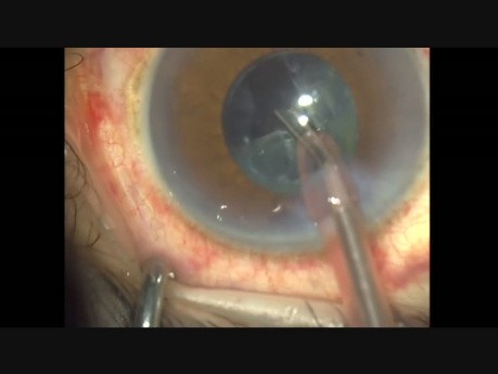 Raccourcir les étapes de la chirurgie de la cataracte