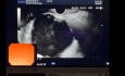 Drainage Endoscopique d'un Pseudokyste Thoraco-Abdominal