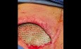 Advanced Chest Wall Reconstruction