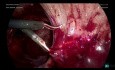 Salpingectomie gauche laparoscopique en raison d'hydrosalpinx et une libération des adhérences - Partie 3