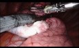 Chirurgie robotique - Exérèse d'une tumeur dans le poumon gauche
