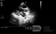 Endocardite infectieuse - végétations sur la valve mitrale