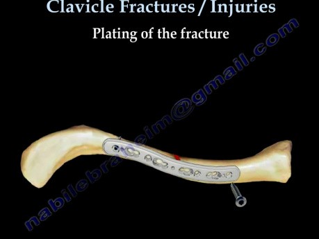 Fracture de la clavicule 