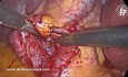 Syndrome de Mirizzi Type I
