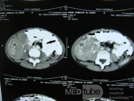 Une intussusception intestinale due à un lymphome non hodgkinien.