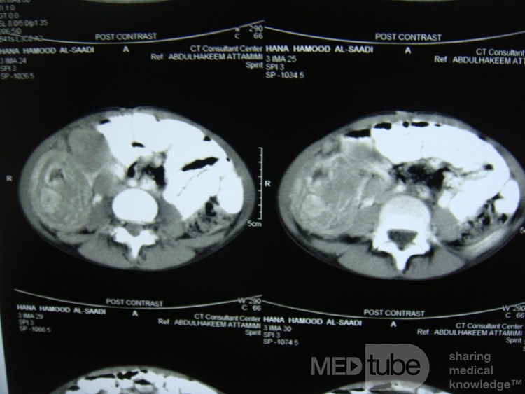 Une intussusception intestinale due à un lymphome non hodgkinien.