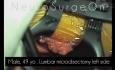Microdiscectomie Lombaire Simple