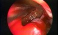 Gros polype du sinus maxillaire - ablation endoscopique