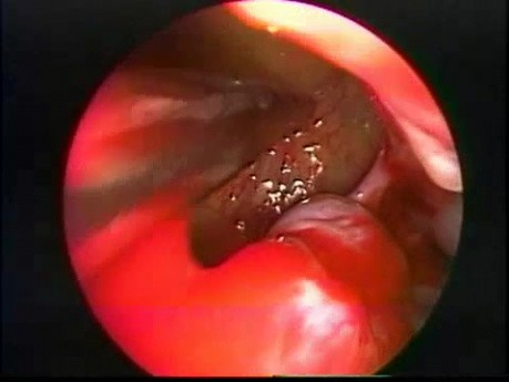 Gros polype du sinus maxillaire - ablation endoscopique