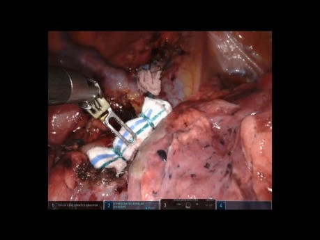 Segmentectomie Robotique S1 du Lobe Supérieur Droit Non-Editée