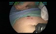 Application - Tutoriel Fundoplicature Géométrie, Chapitre 04 - Mise en place de la suture de rétraction du foie