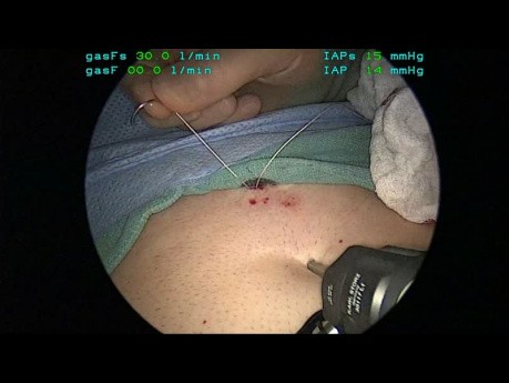 Application - Tutoriel Fundoplicature Géométrie, Chapitre 04 - Mise en place de la suture de rétraction du foie