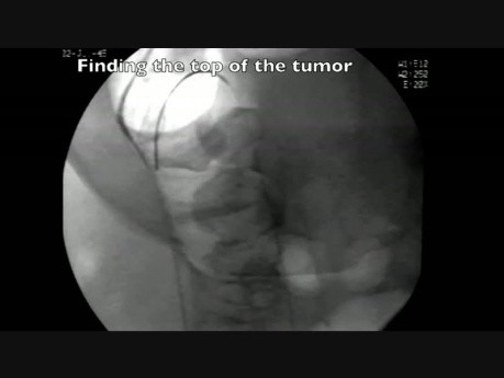 Coloscopie - Prise en charge endoscopique d'une Occlusion du Côlon - Insertion du Stent