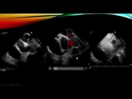 Évaluation Echocardiographique des Masses et Néoplasies Cardiaques 