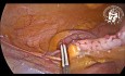 Appendicectomie abdominale