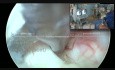 Hernie discale lombaire endoscopique interlaminaire et décompression de l'éperon S1