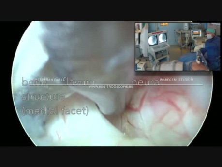 Hernie discale lombaire endoscopique interlaminaire et décompression de l'éperon S1