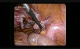 Hystérectomie totale par laparoscopie