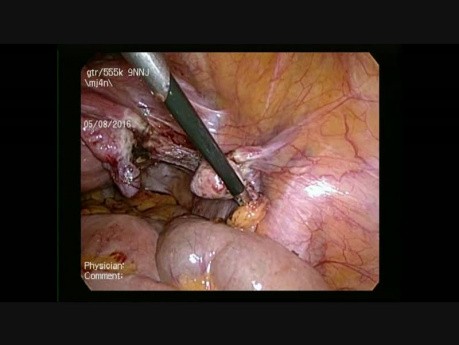 Hystérectomie totale par laparoscopie