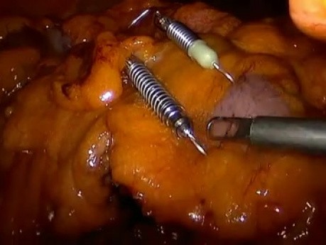 Hémicolectomie droite par laparoscopie en utilisant des ports réduits avec une extraction transvaginale d'une pièce opératoire