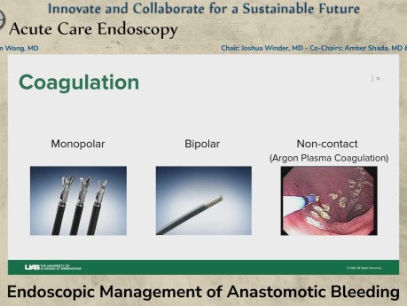 Prise en Charge Endoscopique des Saignements Anastomotiques
