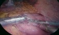 Reprise d'un Pontage Gastrique en Gastrectomie Sleeve pour Hypoglycémie