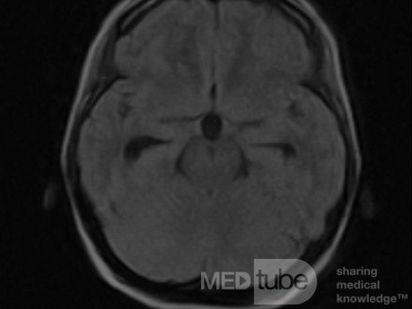  Ventriculostomie endoscopique du troisième ventricule dans un cas bénin du syndrome d'Aicardi avec hydrocéphalie obstructive et malformation de Chiari de type 1.