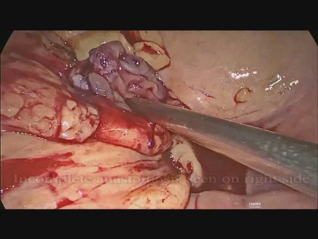 Révision de l'anastomose colorectale après une résection antérieure laparoscopique