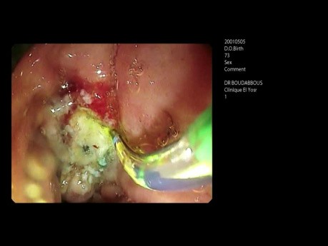  La CPRE (cholangiopancréatographie rétrograde endoscopique) avec ampulectomie.