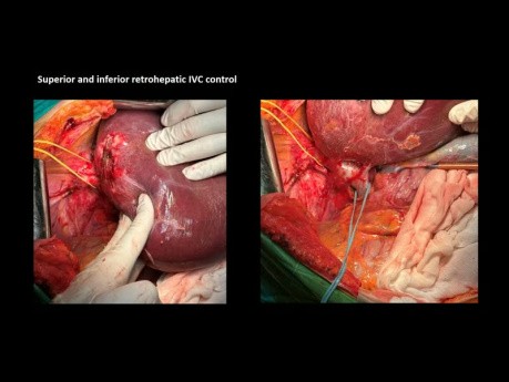 Résection Hépatique Atypique Des Segments 6-7-8 Et Colectomie Gauche Pour Adénocarcinome Synchrone Du Côlon Gauche Et Métastase Hépatique A Segment Unique (7) - Présentation De Cas