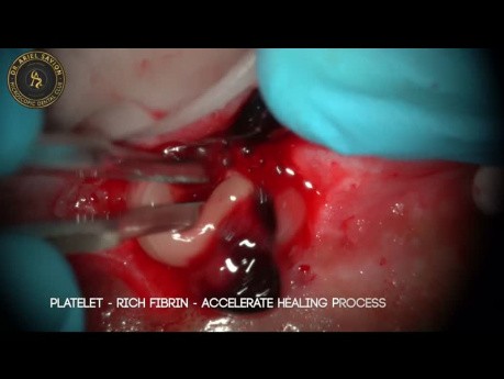 Microchirurgie avec différentes longueurs d'onde lasers (gingivectomie, frénectomie, apicectomie)