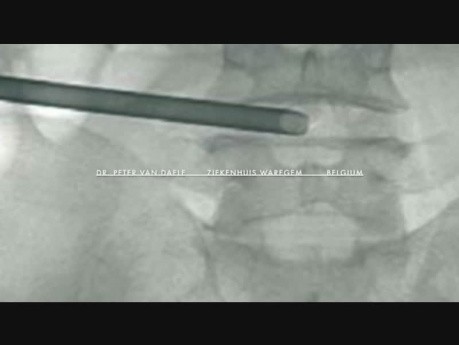 Approche transforaminale latérale extrême endoscopique complète pour discectomie L4-L5