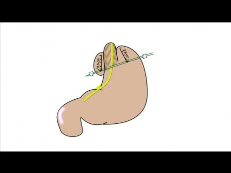 Application - Tutoriel Fundoplicature Géométrie, Chapitre 08 - Animation de création de fundoplicature