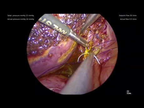 Canal Hépatique Droit Aberrant se Terminant dans un Canal Cystique Court Diagnostiqué lors de Cholécystectomie Laparoscopique