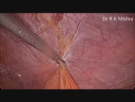 Cure d'éventration médiane par cœlioscopie