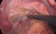 Excision Mésorectale Totale Laparoscopique (EMT) pour Cancer du bas Rectum avec ICG
