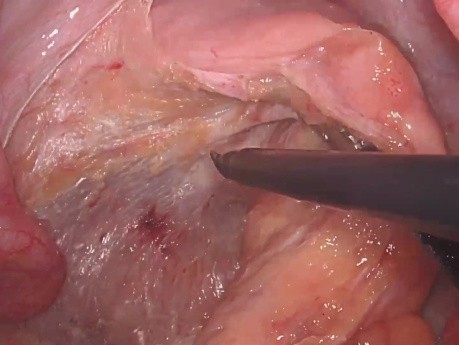 Excision Mésorectale Totale Laparoscopique (EMT) pour Cancer du bas Rectum avec ICG