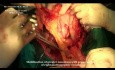 Gastrectomie subtotale proximale pour adénocarcinome gastrique